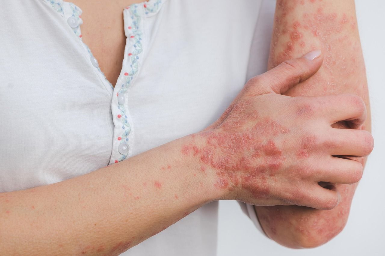 Psoriasis an Hand und Arm